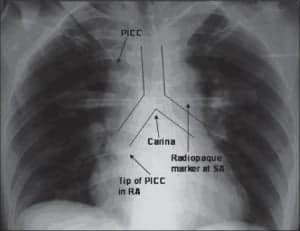 Radiografia torácica mostrando a posição da ponta do cateter PICC na veia cava superior.