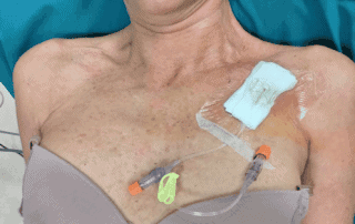 A revolução do PICC-port 2 Portal venoso torácico utilizado para acesso vascular em tratamentos prolongados.