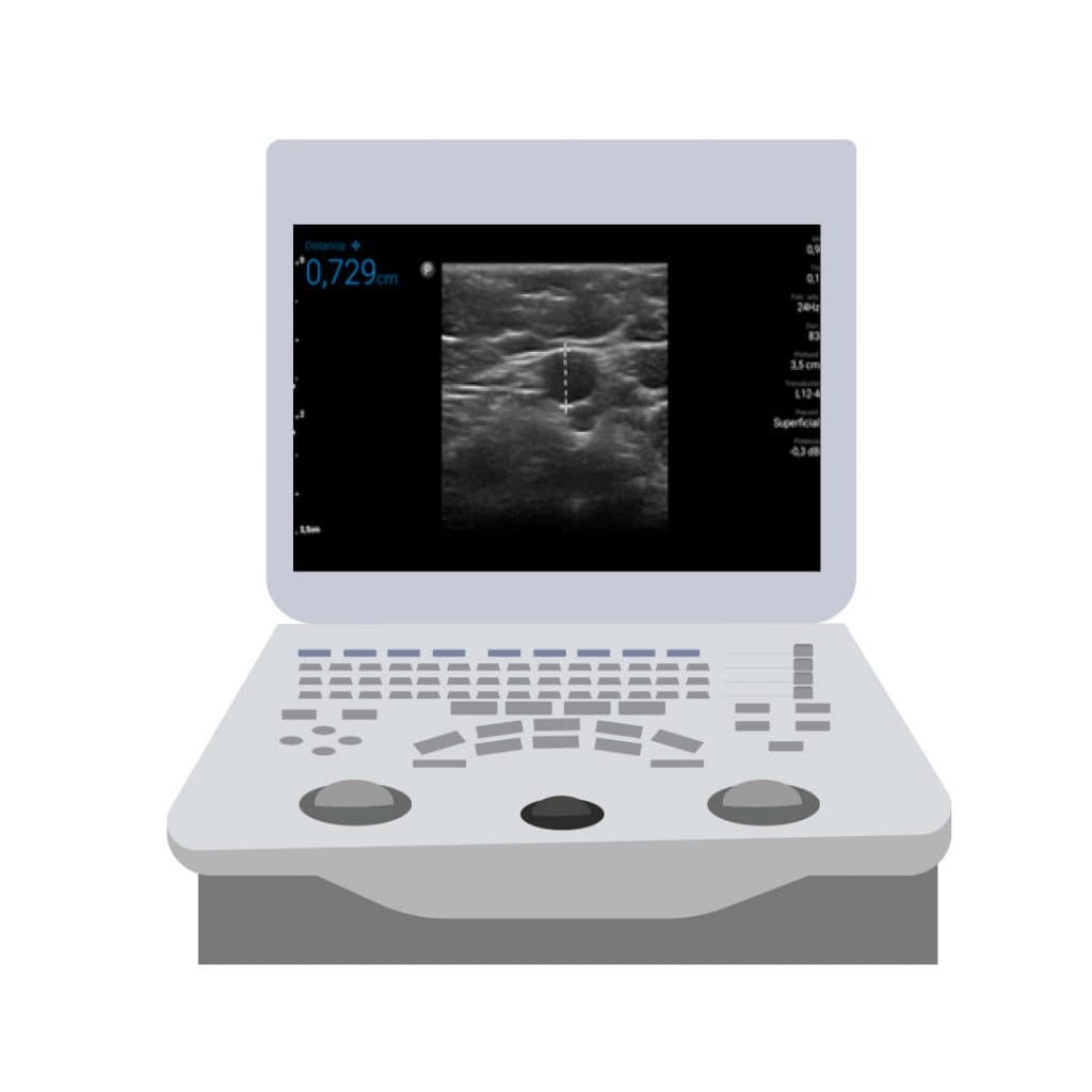 Posicionamento da ponta do PICC-port através de ECG intracavitário