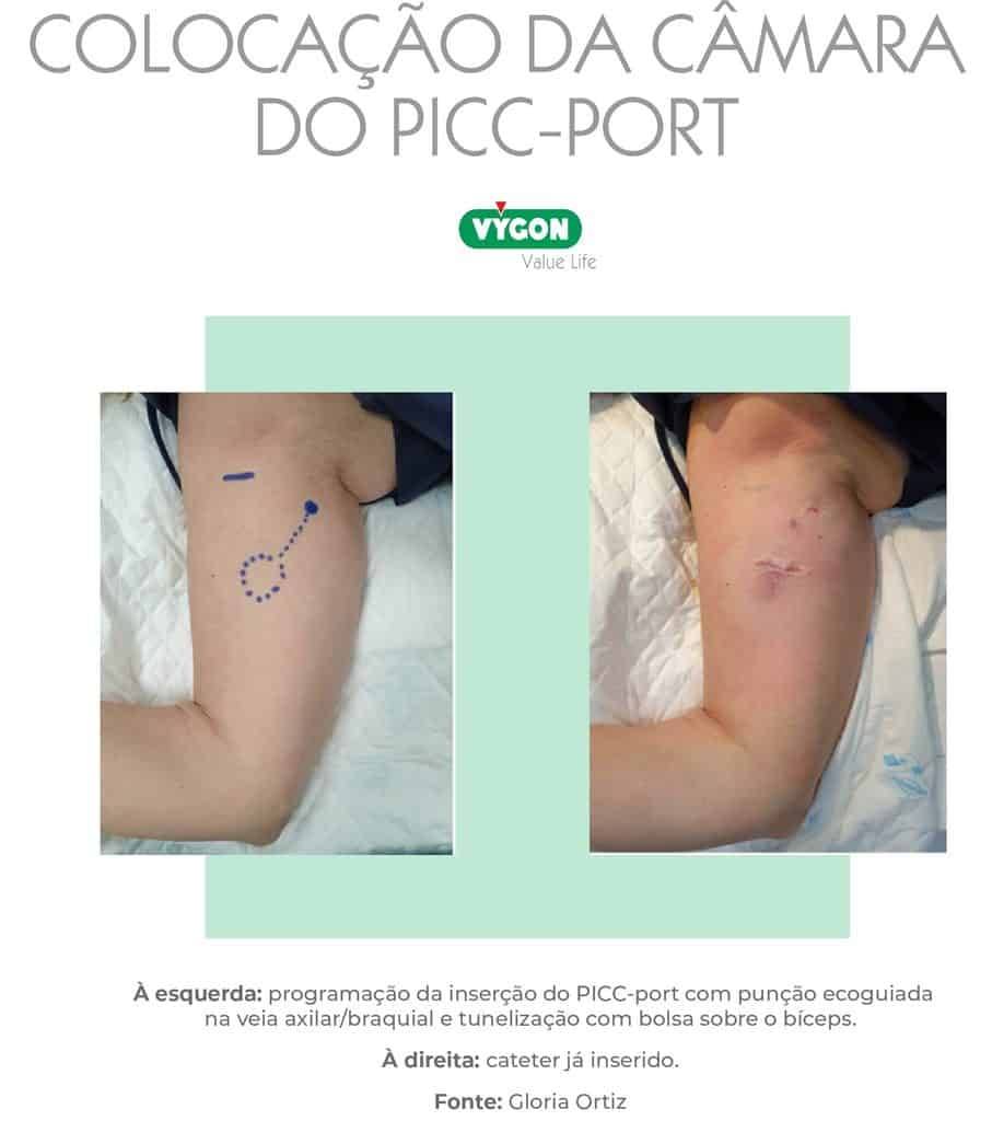 Colocação da câmara do PICC-port com tunelização no braço