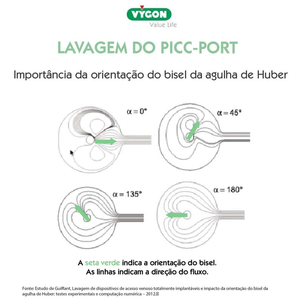 Orientação do bisel da agulha de Huber durante a lavagem do PICC-port