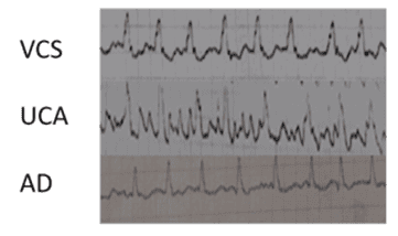 Alterações do ECG intracavitário na VCS, junção cavo-auricular e aurícula direita