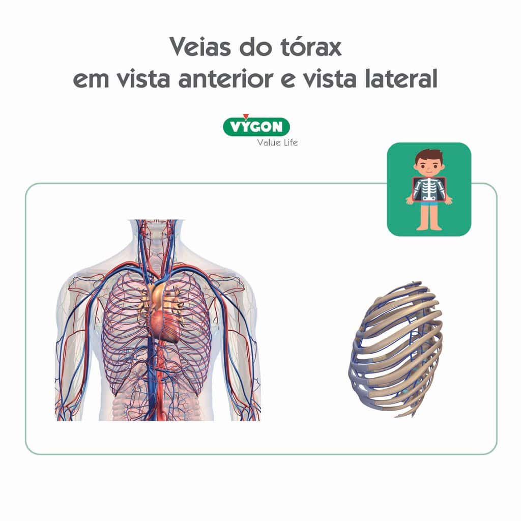 Veias do tórax em vista anterior e lateral para posicionamento de PICC-port