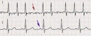 ECG na colocação de PICC em doentes com fibrilhação auricular