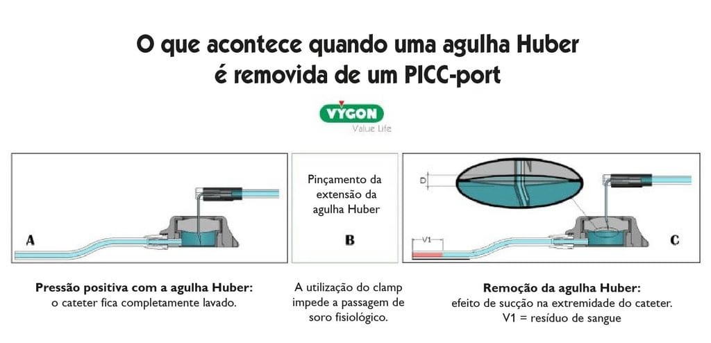 Remoção da agulha de Huber de um PICC-port com pressão positiva