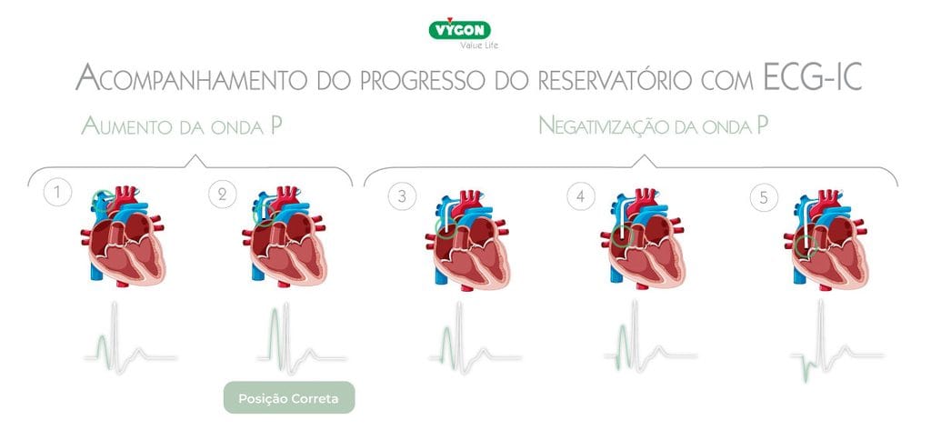 Medição ecográfica da veia para inserção de PICC-port