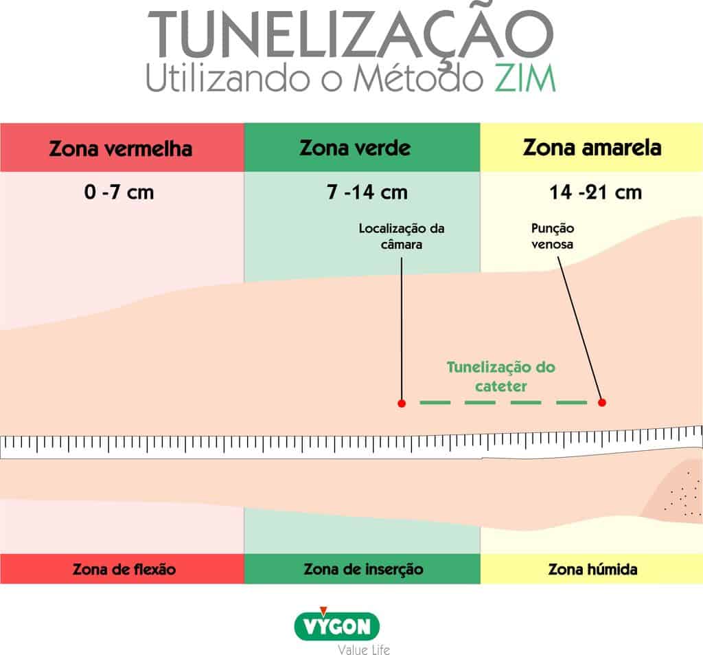Tunelização do PICC-port pelo método ZIM entre a zona amarela e a zona verde