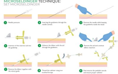 Microseldinger technique