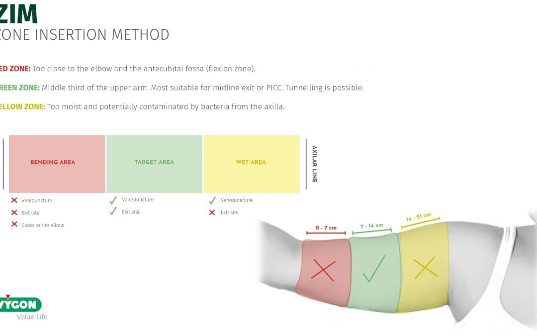 ZIM – Zone Insertion Method