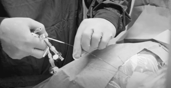 Keys to Central Venous Line (CVC) Maintenance