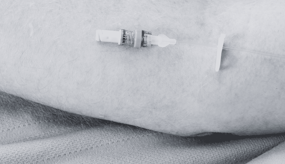 The Importance of Using a Needle Free Connector with a Bi-directional Valve on all IV Lines
