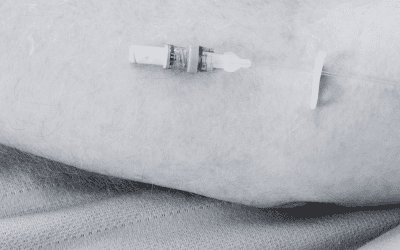 The Importance of Using a Needle Free Connector with a Bi-directional Valve on all IV Lines