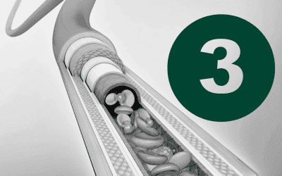 Article 3: Choosing the Right Device for the Right Patient