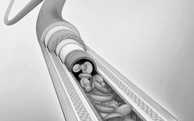 Mastering Arterial Line Placement Guide