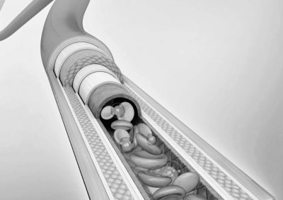 Mastering Arterial Line Placement Guide