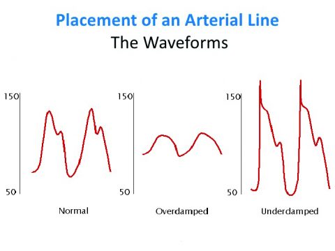 Square Line Test Best Practices for Arterial Line Placement - Campus Vygon UK