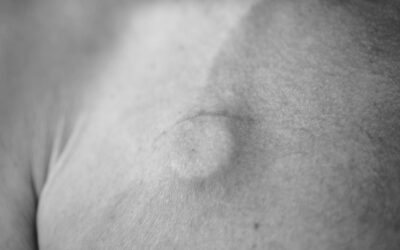 The SaRePo Protocol: A Seven Step Strategy to Minimise Complications Potentially Related to the Removal of Totally Implanted Central Venous Access Devices