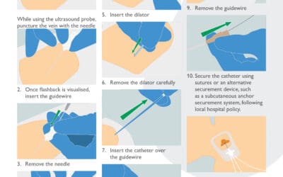 CVC Insertion Procedure