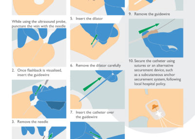 CVC Insertion Procedure