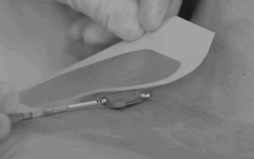 The Risks Associated with Traditional CVC Securement: How SASS Devices Support Risk Mitigation Strategies