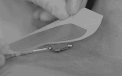 The Risks Associated with Traditional CVC Securement: How SASS Devices Support Risk Mitigation Strategies