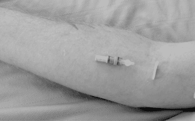 Overcoming Catheter Occlusion: Why TKO Remains a Reliable Approach to Maintaining Patency