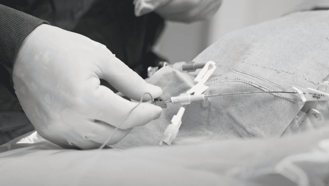 ECG-Guided Central Venous Catheter Placement: Advancing Accuracy and Efficiency at the Bedside