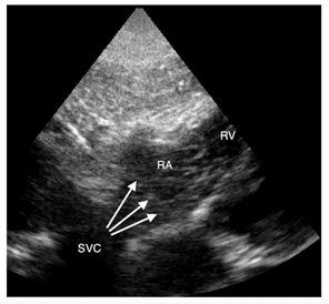 Imagen 5: visualización de CEUS con microburburjas en la aurícula derecha. Las flechas indican el flujo desde vena cava superior. Cortellaro F, et al. 2014. 