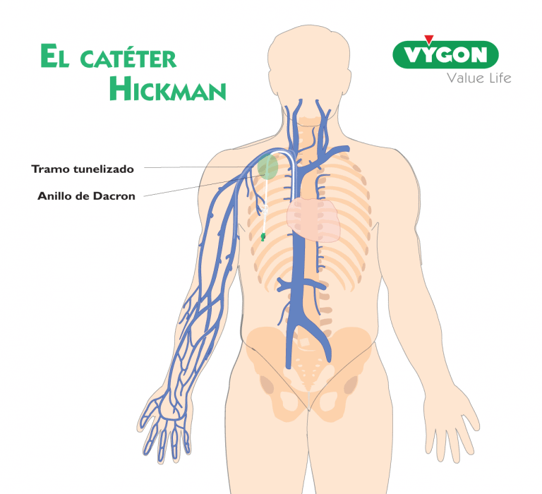 El catéter Hickman ¿qué es y para qué sirve? Campus Vygon