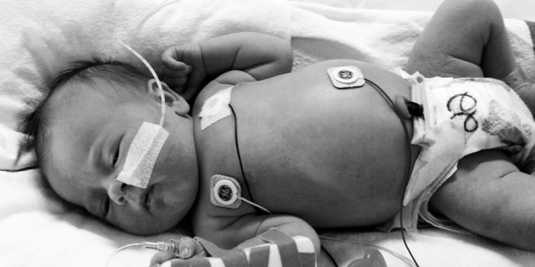 ¿Qué catéter elegir como acceso venoso en neonatos?