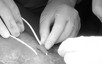 3 cosas que debes saber sobre los sistemas de fijación sin suturas