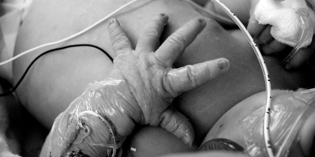Whitepaper: ¿Por qué la jeringa de bajo volumen (LDT) NO elimina los riesgos de sobredosis en neonatos?