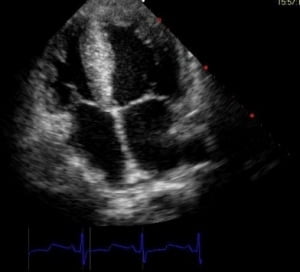 How to locate the tip of a PICC - Echocardiography