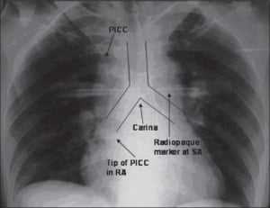 How to locate the tip of a PICC - X-Ray