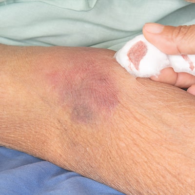 agotamiento-vascular-portada-400