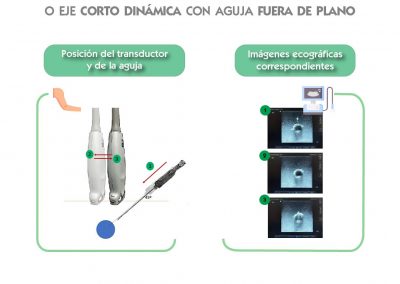 Técnica ecográfica dinámica en plano transversal