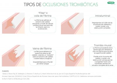 Tipos de oclusiones trombóticas
