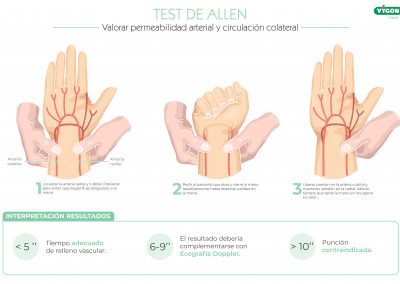 Test de Allen – Canalización arteria radial