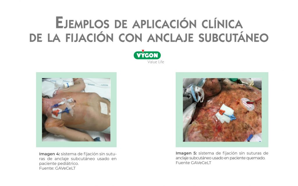 3 Motivos Por Los Que Dejar De Suturar Un Acceso Vascular Campus Vygon