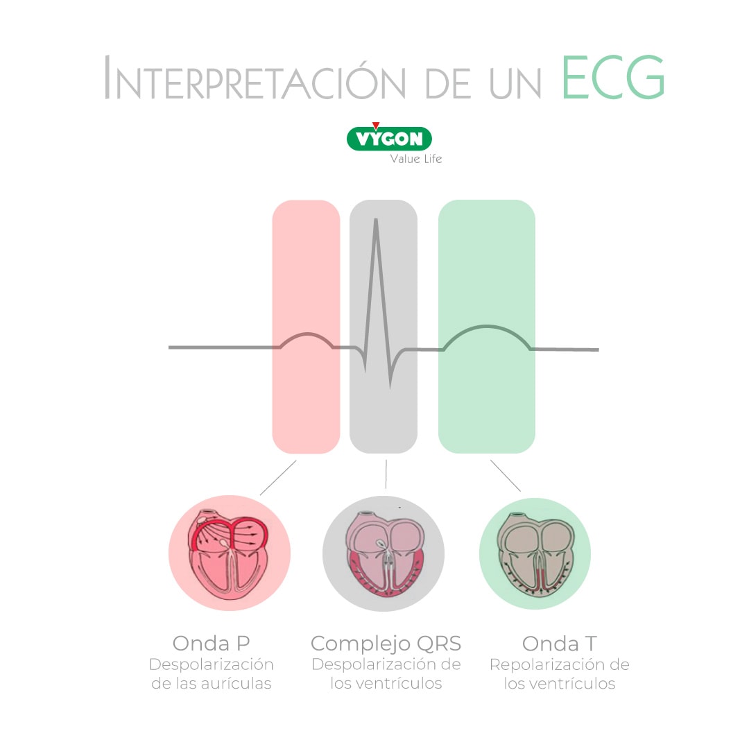 interpretación del electrocardiograma