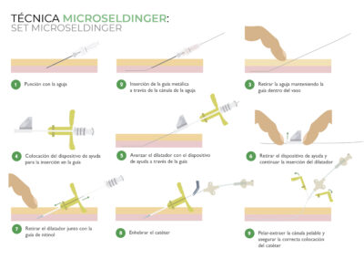 Canalización PICC neonatal con Técnica microseldinger: set microseldinger