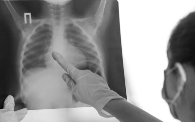 3 razones para dejar de usar la radiografía como método de comprobación del acceso venoso central pediátrico