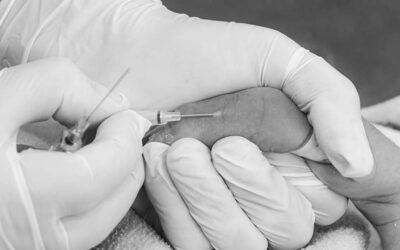 Claves para una canalización arterial exitosa en neonatología