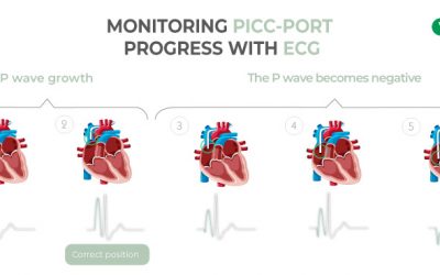 Monitoring PICC Port progress with ECG