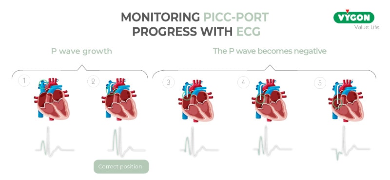 Monitoring PICC Port progress with ECG