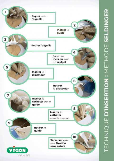 Technique d'insertion : Méthode Seldinger - Campus Vygon