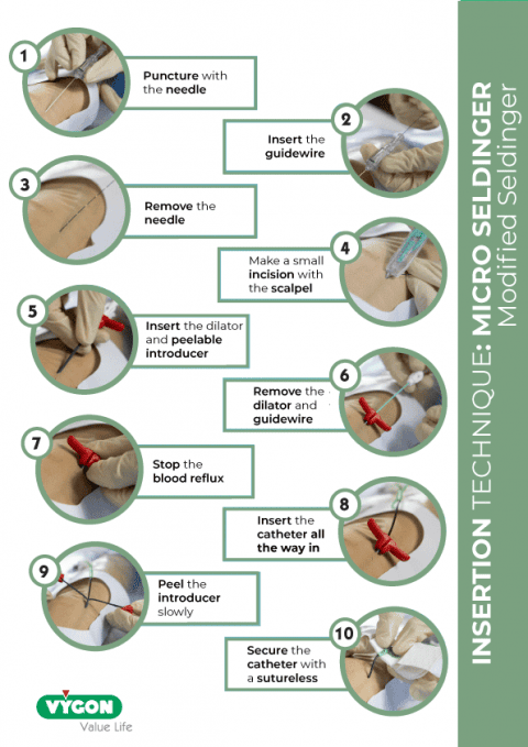 Insertion technique: micro seldinger modified seldinger - Campus Vygon