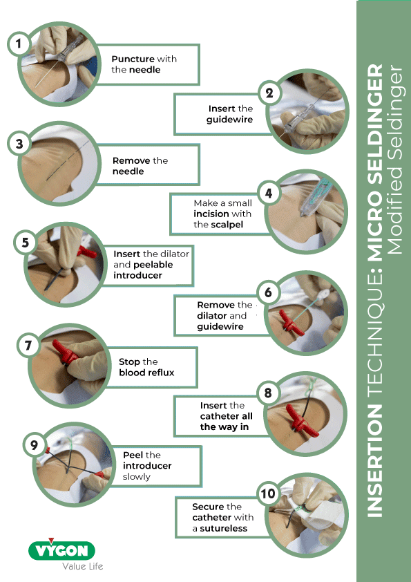 Catheter-Insertion-Micro-Seldinger-Technique
