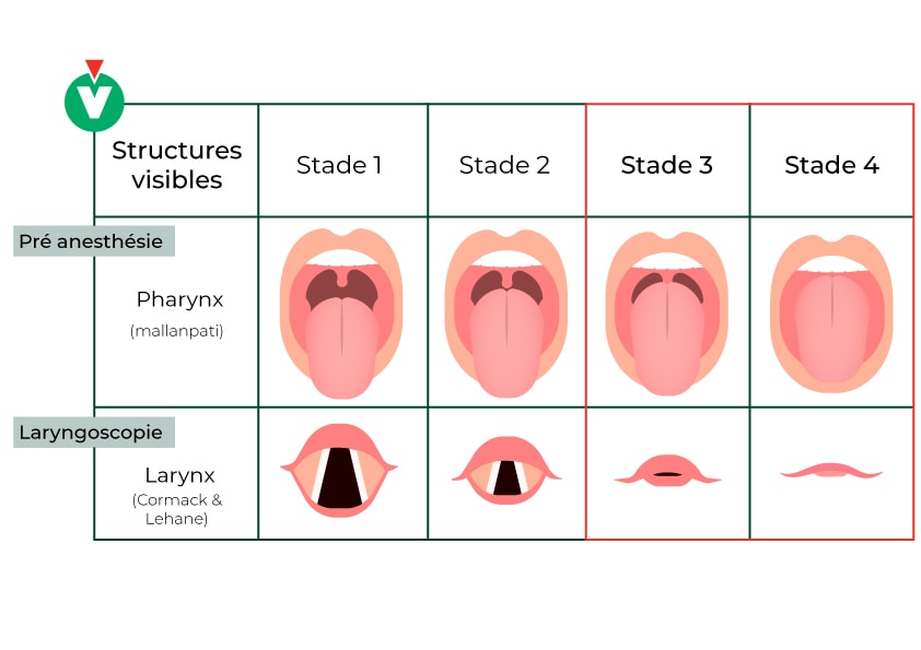 Echelles de Mallanpati, de Cormack et Lehane sur pharynx et larynx