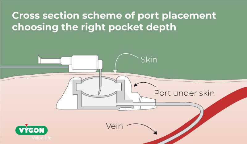 Cross section illustration of port placement choosing the right pocket depth
